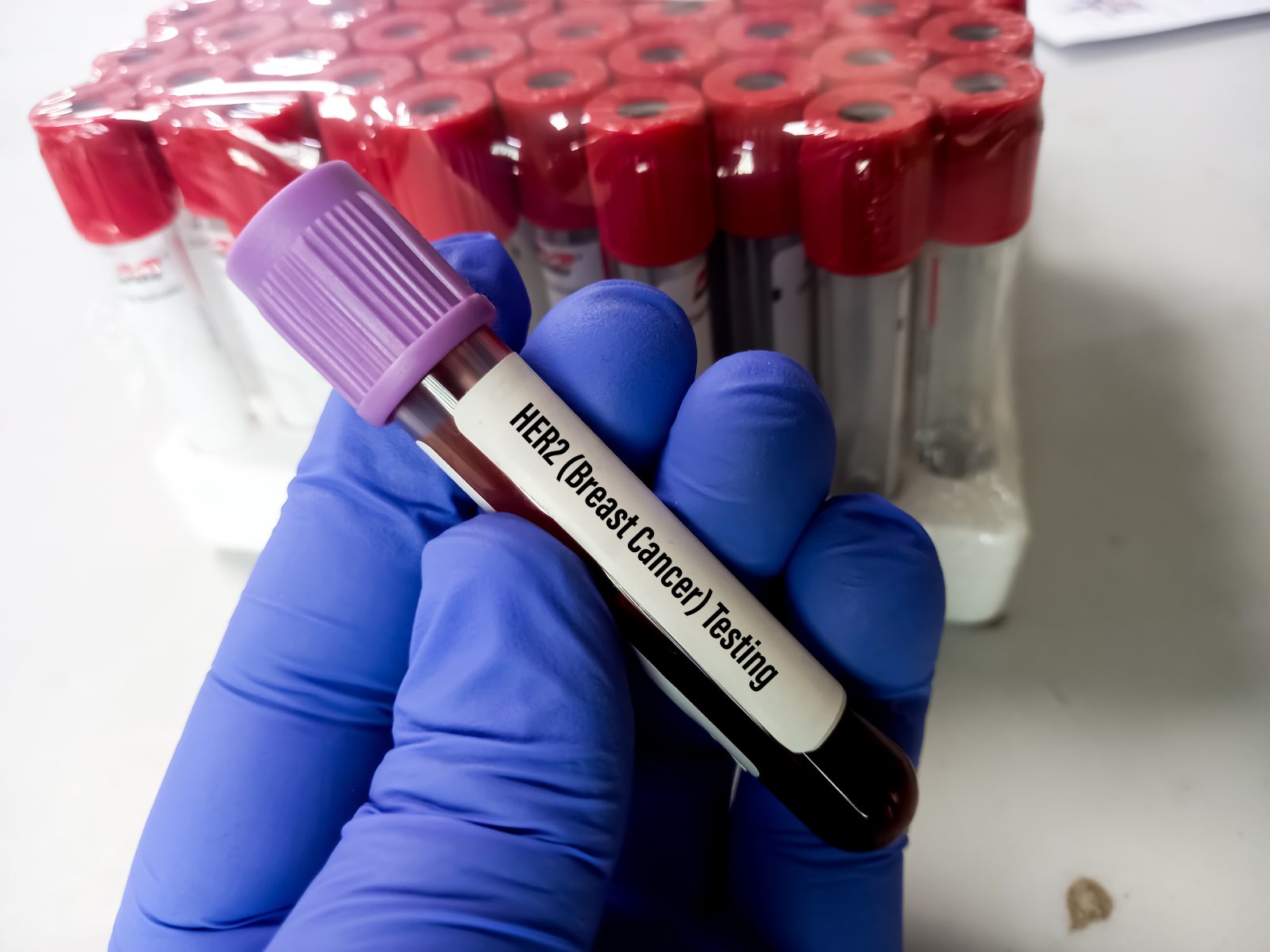 Auburn University at Montgomery lab gloved hand holds HER2 breast cancer testing blood vial amid test tubes